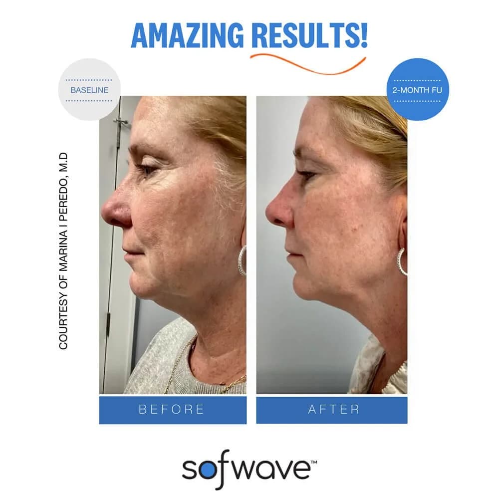 Sofwave vs. Ultherapy vs. Thermage: Which Skin Tightening Treatment Is Right for You?