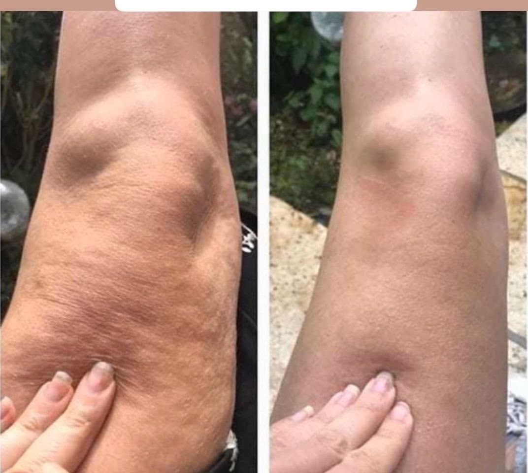 DermaShape Lymphatic Drainage